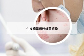 牛皮癬是哪種細(xì)菌感染