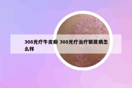 308光療牛皮癬 308光療治療銀屑病怎么樣