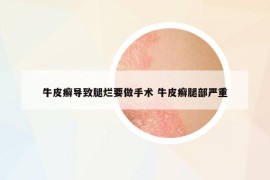 牛皮癬導(dǎo)致腿爛要做手術(shù) 牛皮癬腿部嚴(yán)重