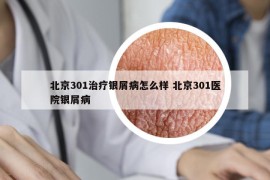 北京301治療銀屑病怎么樣 北京301醫(yī)院銀屑病