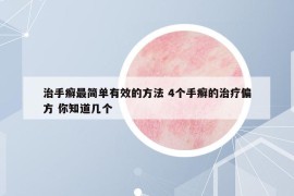 治手癬最簡單有效的方法 4個手癬的治療偏方 你知道幾個