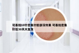 可善挺10針密集針臉部沒效果 可善挺密集針后30天大復發(fā)