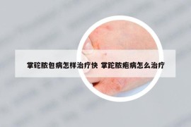 掌砣膿包病怎樣治療快 掌跎膿皰病怎么治療