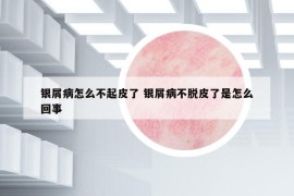 銀屑病怎么不起皮了 銀屑病不脫皮了是怎么回事