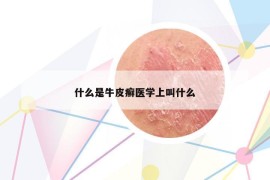 什么是牛皮癬醫(yī)學(xué)上叫什么