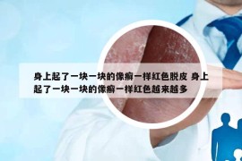 身上起了一塊一塊的像癬一樣紅色脫皮 身上起了一塊一塊的像癬一樣紅色越來(lái)越多