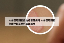 人參茯苓顆粒能治療銀屑病嗎 人參茯苓顆粒能治療銀屑病嗎怎么服用