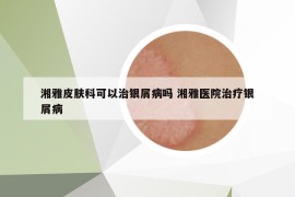湘雅皮膚科可以治銀屑病嗎 湘雅醫(yī)院治療銀屑病