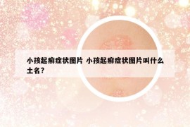 小孩起癬癥狀圖片 小孩起癬癥狀圖片叫什么土名?