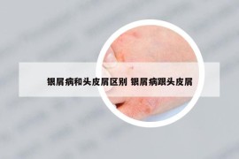 銀屑病和頭皮屑區(qū)別 銀屑病跟頭皮屑
