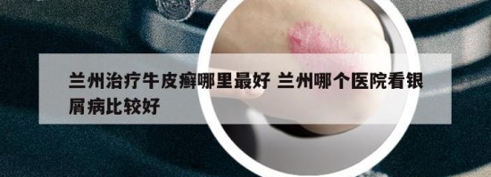 蘭州治療牛皮癬哪里最好 蘭州哪個(gè)醫(yī)院看銀屑病比較好