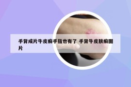 手背成片牛皮癬手指也有了 手背牛皮膚癬圖片