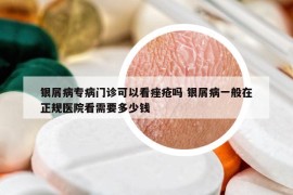 銀屑病專病門診可以看痤瘡嗎 銀屑病一般在正規(guī)醫(yī)院看需要多少錢