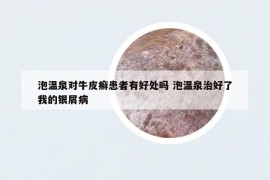 泡溫泉對(duì)牛皮癬患者有好處嗎 泡溫泉治好了我的銀屑病