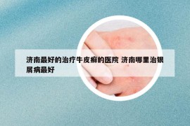 濟(jì)南最好的治療牛皮癬的醫(yī)院 濟(jì)南哪里治銀屑病最好