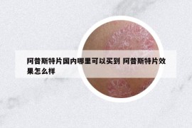 阿普斯特片國內(nèi)哪里可以買到 阿普斯特片效果怎么樣