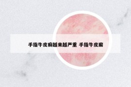 手指牛皮癬越來越嚴重 手指牛皮廨