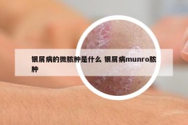 銀屑病的微膿腫是什么 銀屑病munro膿腫