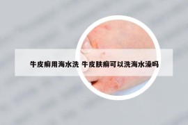牛皮癬用海水洗 牛皮膚癬可以洗海水澡嗎
