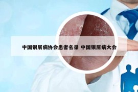 中國銀屑病協(xié)會(huì)患者名錄 中國銀屑病大會(huì)