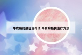 牛皮癬的最佳治療法 牛皮癬最快治療方法