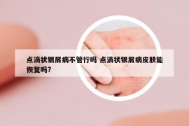 點滴狀銀屑病不管行嗎 點滴狀銀屑病皮膚能恢復嗎?