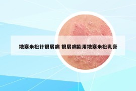 地塞米松針銀屑病 銀屑病能用地塞米松乳膏