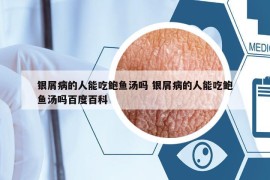 銀屑病的人能吃鮑魚湯嗎 銀屑病的人能吃鮑魚湯嗎百度百科