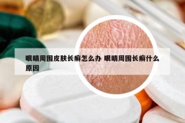 眼睛周圍皮膚長癬怎么辦 眼睛周圍長癬什么原因