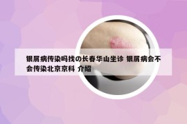 銀屑病傳染嗎找の長(zhǎng)春華山坐診 銀屑病會(huì)不會(huì)傳染北京京科 介紹