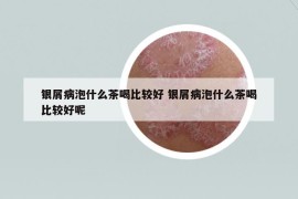 銀屑病泡什么茶喝比較好 銀屑病泡什么茶喝比較好呢