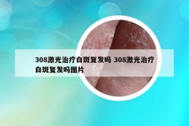 308激光治療白斑復(fù)發(fā)嗎 308激光治療白斑復(fù)發(fā)嗎圖片