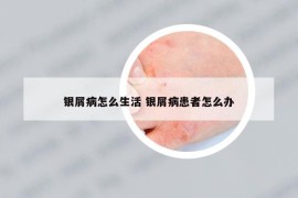 銀屑病怎么生活 銀屑病患者怎么辦