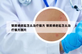 銀屑病老起怎么治療偏方 銀屑病老起怎么治療偏方圖片