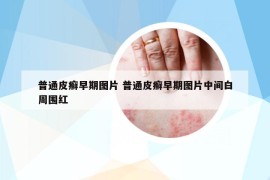 普通皮癬早期圖片 普通皮癬早期圖片中間白周圍紅