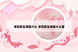 掌拓膿包病是什么 掌拓膿包病是什么菌