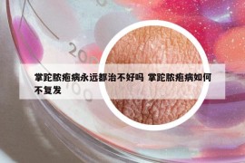 掌跎膿皰病永遠都治不好嗎 掌跎膿皰病如何不復(fù)發(fā)