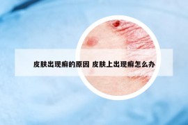 皮膚出現(xiàn)癬的原因 皮膚上出現(xiàn)癬怎么辦