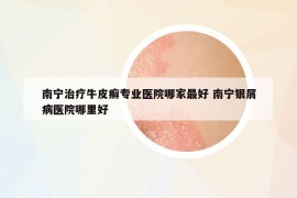 南寧治療牛皮癬專業(yè)醫(yī)院哪家最好 南寧銀屑病醫(yī)院哪里好
