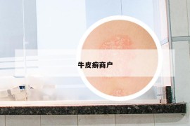 牛皮癬商戶
