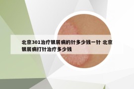 北京301治療銀屑病的針多少錢一針 北京銀屑病打針治療多少錢