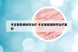 手足銀屑病如何治療 手足銀屑病如何治療最好