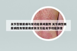 關(guān)節(jié)型銀屑病與腎功能衰竭案例 關(guān)節(jié)病性銀屑病既有銀屑病皮損又引起關(guān)節(jié)功能損害