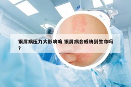 銀屑病壓力大影響嘛 銀屑病會威脅到生命嗎?