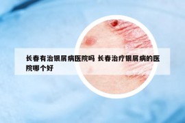 長(zhǎng)春有治銀屑病醫(yī)院?jiǎn)?長(zhǎng)春治療銀屑病的醫(yī)院哪個(gè)好