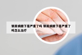 銀屑病腋下是嚴(yán)重了嗎 銀屑病腋下是嚴(yán)重了嗎怎么治療