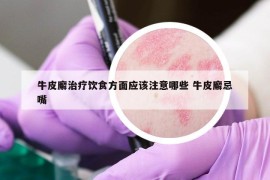 牛皮廨治療飲食方面應(yīng)該注意哪些 牛皮廨忌嘴