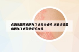 點(diǎn)滴狀銀屑病兩年了還能治好嗎 點(diǎn)滴狀銀屑病兩年了還能治好嗎女性
