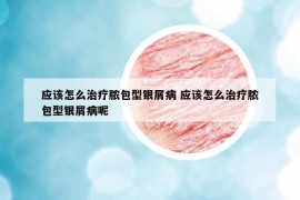 應(yīng)該怎么治療膿包型銀屑病 應(yīng)該怎么治療膿包型銀屑病呢