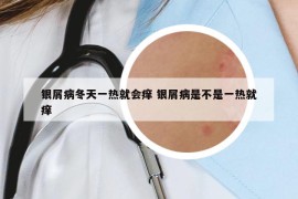 銀屑病冬天一熱就會癢 銀屑病是不是一熱就癢